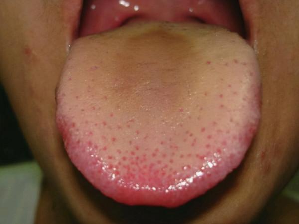 溼熱體質的這6點你佔了幾個？判斷是脾胃溼熱還是肝膽溼熱是重點