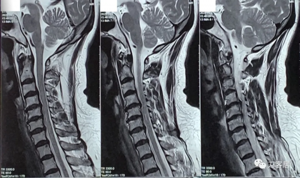 查體的重要性，一直按照腰椎間盤突出症治療的脊髓型頸椎病