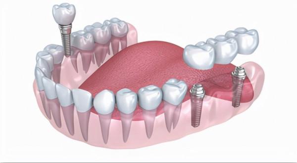 假牙的種類及價格，你知道嗎？