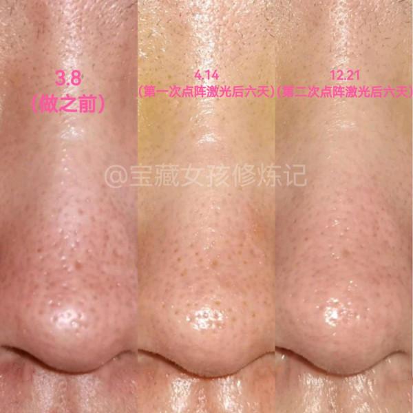 我把買sk2的錢拿去三甲醫院搞醫美了