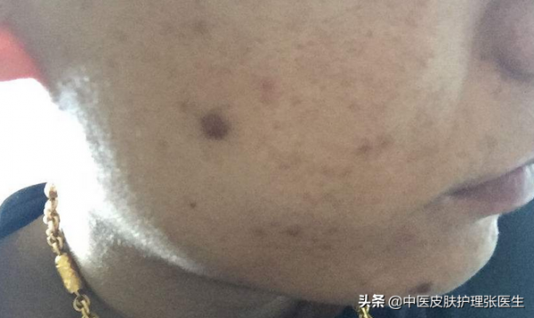 色斑是如何形成的？我的臉上是那哪種色斑？張醫生一次給你講清