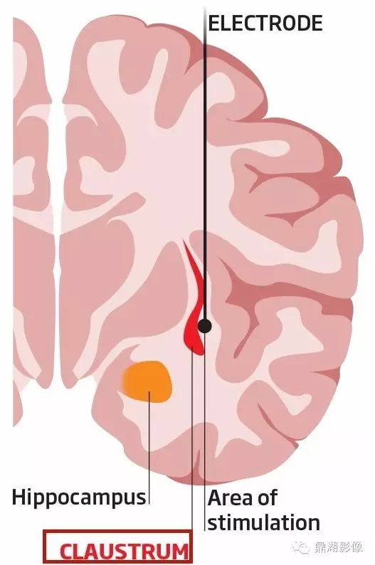基底節的詳細解剖