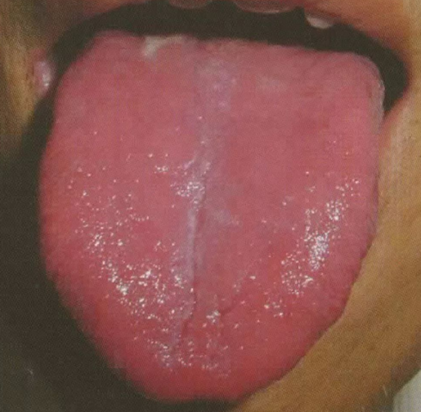 中醫論治糖尿病，不同證型的糖尿病該如何治療？快看看你是哪一種