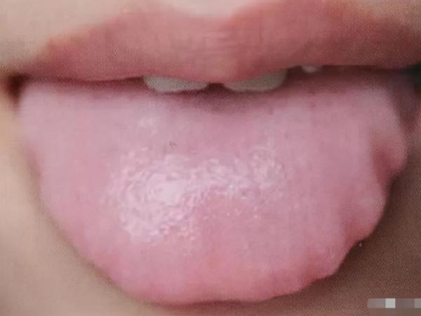 舌頭邊緣有齒痕，舌苔中間有裂紋？3種齒痕5種裂紋，你是哪一種？