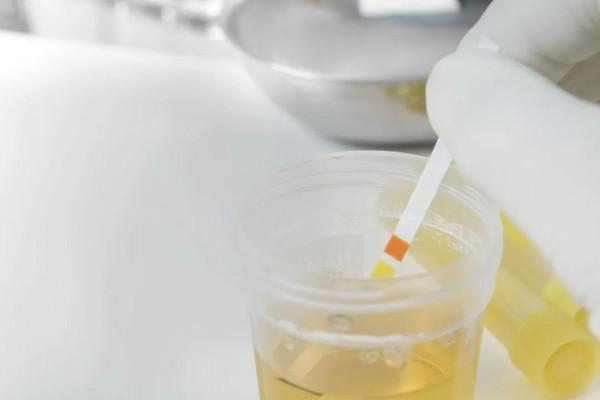 別大意！小便裡泡沫越多，代表&OpenCurlyDoubleQuote;腎病&rdquo;越嚴重？聽聽醫生怎麼說