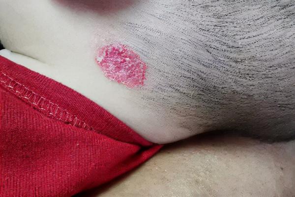 莫把血管瘤當胎記,嬰幼兒治療要趁早 莫把血管瘤當胎記,嬰幼兒治療要趁早