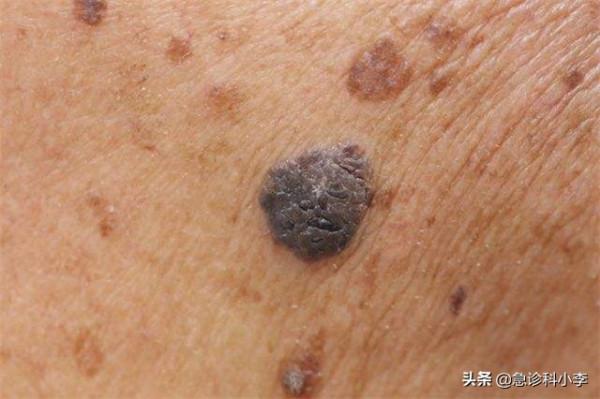 身上出現很多小紅點，不痛不癢是怎麼回事？聽聽醫生怎麼說