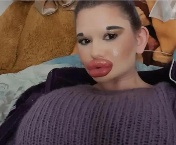 女子花費5萬元整形27次，收穫“麵包嘴”，她表示：現在自信多了