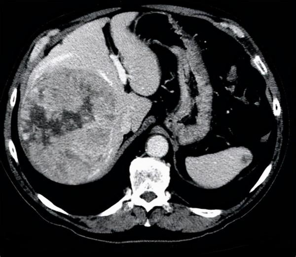55歲突然發胖，醫生卻說是水腫？4種常見原因，表現各不相同