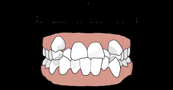 為什麼只要戴牙套,牙齒就可以恢復得很整齊?生動展示矯正過程 為什麼只要戴牙套,牙齒就可以恢復得很整齊?生動展示矯正過程