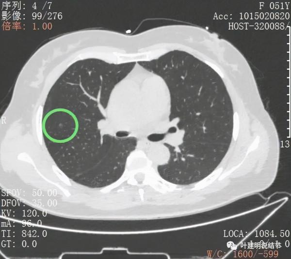 指南說小於5毫米的肺結節不需要隨訪，打臉來了