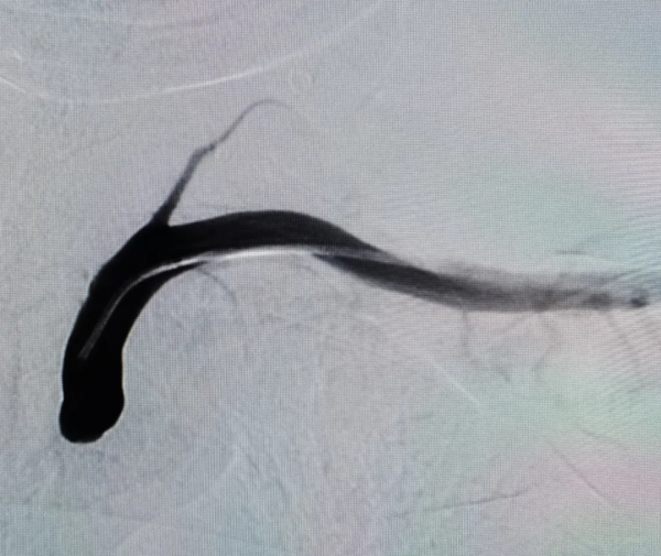 北京老年醫院成功完成經橈動脈入路慢性鎖骨下動脈閉塞再通術 北京老年醫院成功完成經橈動脈入路慢性鎖骨下動脈閉塞再通術