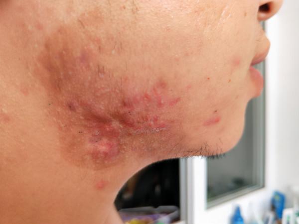 痘痘疤痕增生鼓起來了怎麼辦? 痘痘疤痕增生鼓起來了怎麼辦?