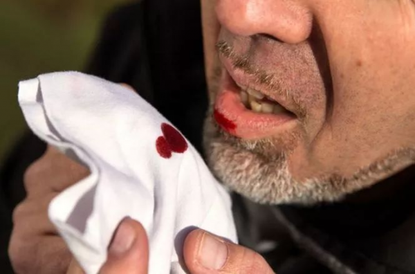 肺癌合併大咯血，如不及時處理，易導致窒息和休克