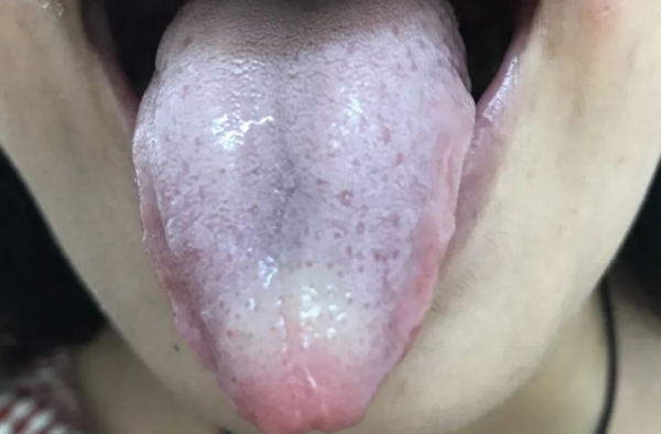 一補就上火?舌頭有齒痕,舌苔比較厚?這7種舌象不要著急進補 一補就上火?舌頭有齒痕,舌苔比較厚?這7種舌象不要著急進補