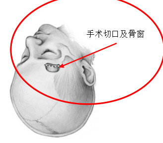 內鏡微創手術&mdash;&mdash;嗅溝腦膜瘤患者的福音