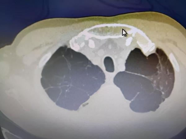 肺大皰是什麼，有哪些危害？