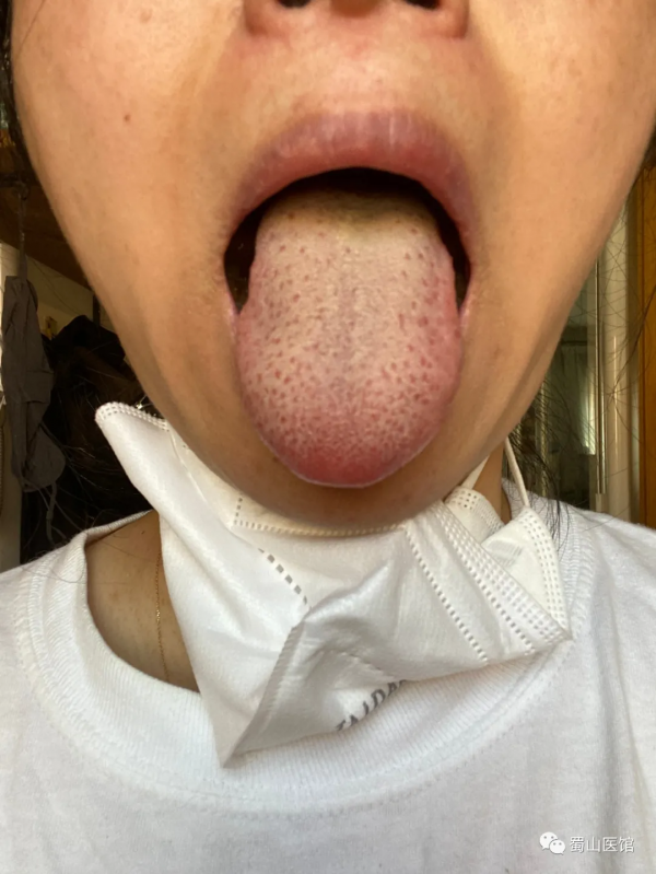 西班牙華人確診新冠，急忙找中醫遠端治療，服中成藥三天退熱