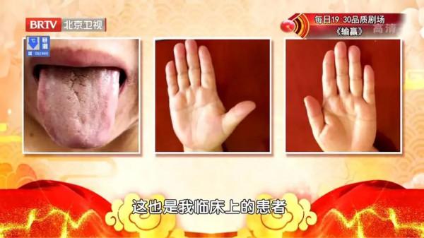 體內有水溼、血瘀，手舌會有這些特點！兩個食療方，利小便、調血分