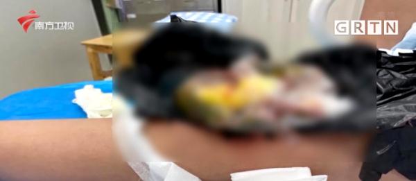 又險又疼!一孕媽走路撞到牆,手裡的魚骨還刺入大腿…… 又險又疼!一孕媽走路撞到牆,手裡的魚骨還刺入大腿……