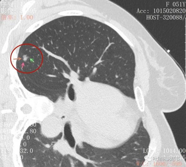 指南說小於5毫米的肺結節不需要隨訪，打臉來了