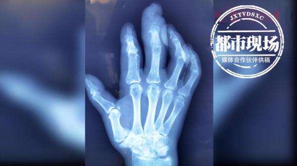 男子木刺扎手不重視，拖延2個月後半段中指被切除