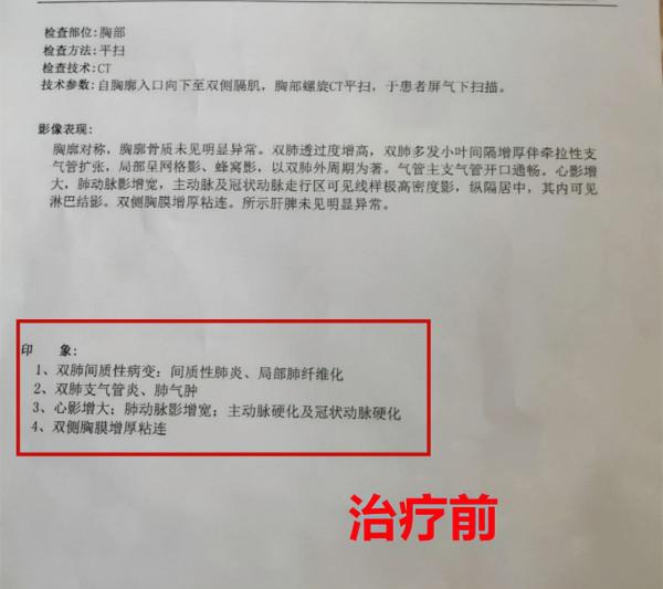 身患肺氣腫、支氣管炎、肺纖維化,40年煙齡的肺也有救 身患肺氣腫、支氣管炎、肺纖維化,40年煙齡的肺也有救