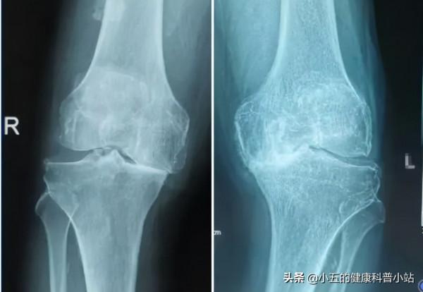 膝關節咔咔作響,上下樓疼痛不適,髕骨軟化症到底該如何治療 膝關節咔咔作響,上下樓疼痛不適,髕骨軟化症到底該如何治療