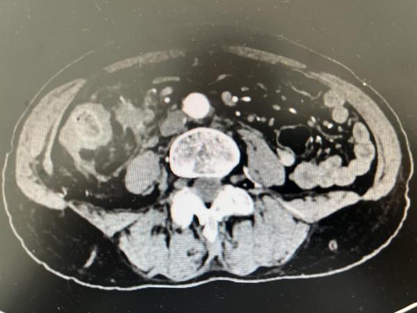 河南省人民醫院胃腸外科李丹主任團隊成功救治一名結腸癌晚期患者 河南省人民醫院胃腸外科李丹主任團隊成功救治一名結腸癌晚期患者