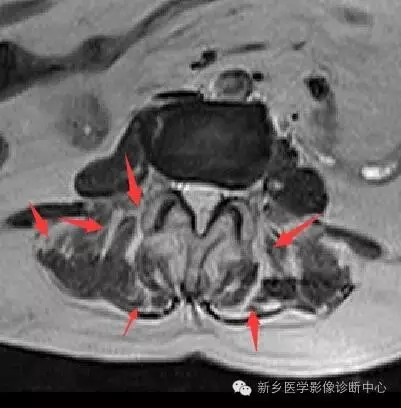 骶椎腰化/腰椎骶化、腰椎滑脫、腰肌勞損，簡單易懂圖解