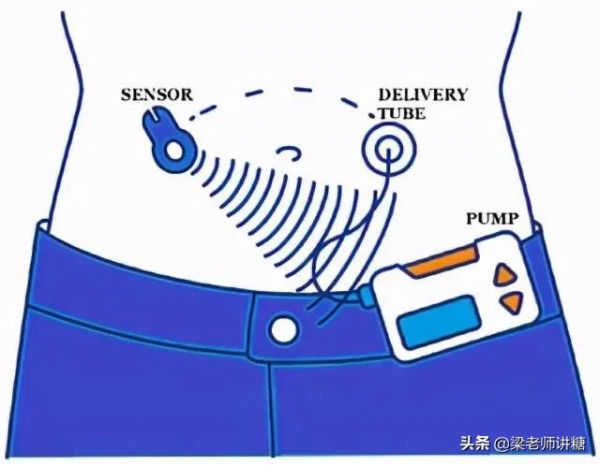 科技的發展，讓醫生也面臨失業，閉環胰島素泵讓控糖不再難