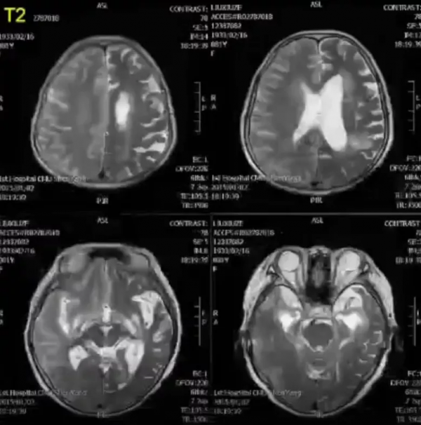 急性腦梗死MRI的臨床特點，超強解讀