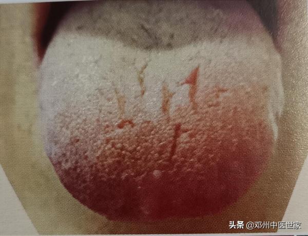 腹痛、溼熱壅滯的舌象
