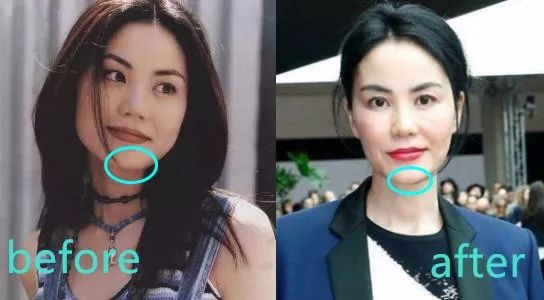 王菲氣質更多來自顴骨和身材，如今鼻子卻攣縮了，逃不過變蔡明