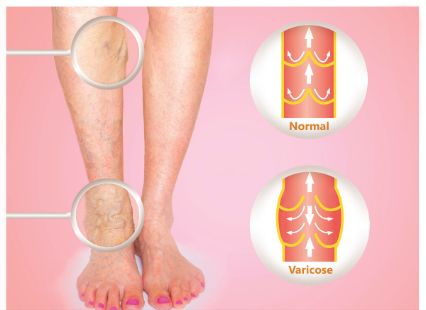 雙腿反映全身病，千萬要留意！腿上的5個疾病訊號，快來自查