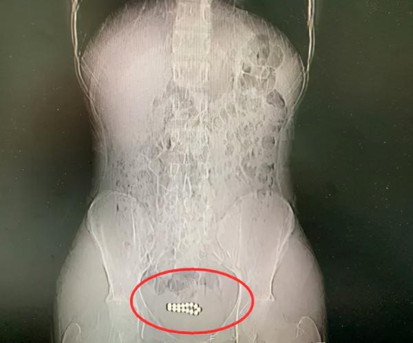 15顆磁力珠，膀胱裡連成一圈，泌尿外科醫生都取出過啥東西？