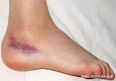 如何選用腳踝護具