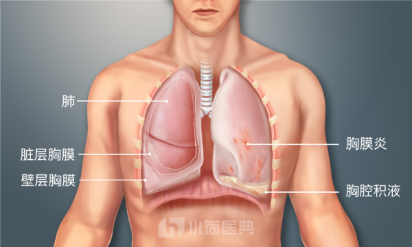 胸膜炎疼痛位置