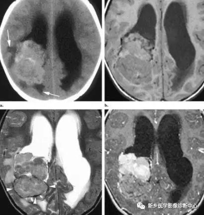 在側腦室三角區看到佔位，要想到這8種腫瘤