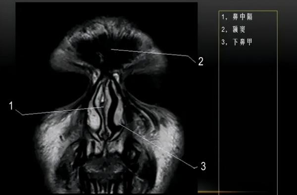 MRI下眼部及鼻竇解剖