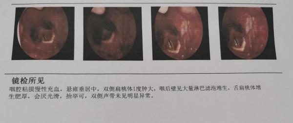 咽部異物感、咽部疼痛不僅僅是因為咽炎