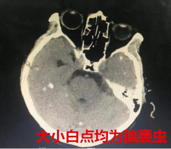 60歲女子腦中取出一條條小&OpenCurlyDoubleQuote;魚&rdquo;！潛伏長達40年，危害究竟多大？