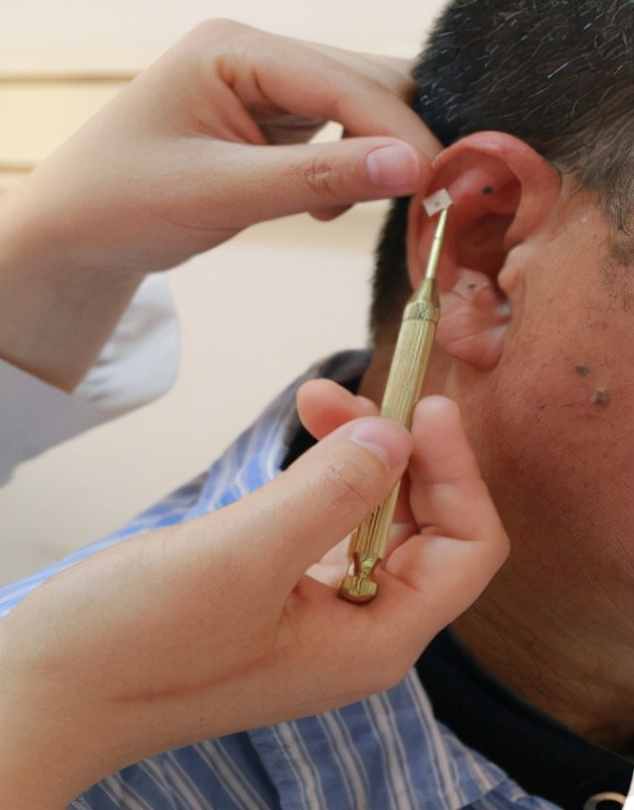 耳穴埋豆療法,減輕術後疼痛 耳穴埋豆療法,減輕術後疼痛