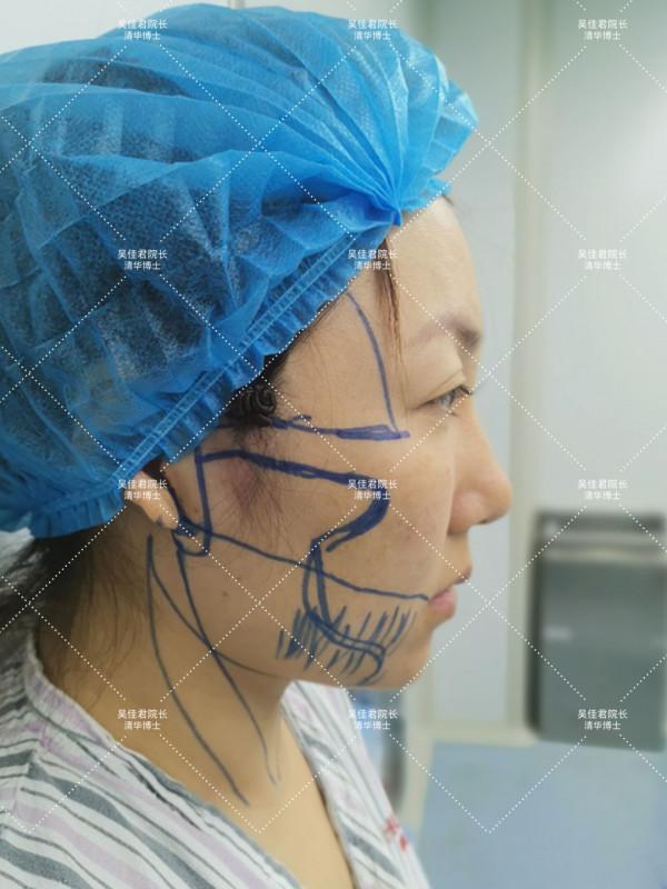 38歲小拉皮術後5個月,跟大家說一說我的經歷 38歲小拉皮術後5個月,跟大家說一說我的經歷