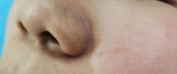 整形美容手術:帶你認識鼻翼縮小術 整形美容手術:帶你認識鼻翼縮小術