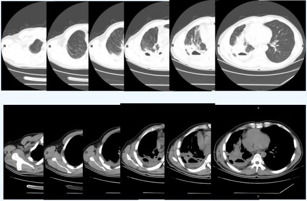 多線治療後復發的PD-L1陰性晚期肺鱗癌,替雷利珠單抗聯合化療帶來有效緩解 多線治療後復發的PD-L1陰性晚期肺鱗癌,替雷利珠單抗聯合化療帶來有效緩解