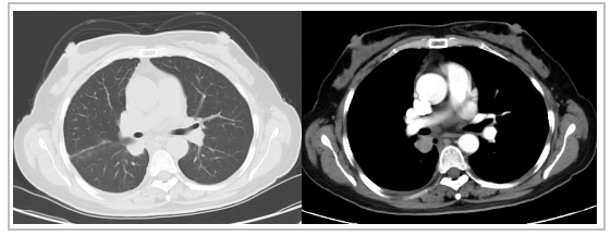 王哲海教授組稿 | 韓曉：1例EGFR突變晚期肺腺癌採用一線吉非替尼聯合貝伐珠單抗治療的思考