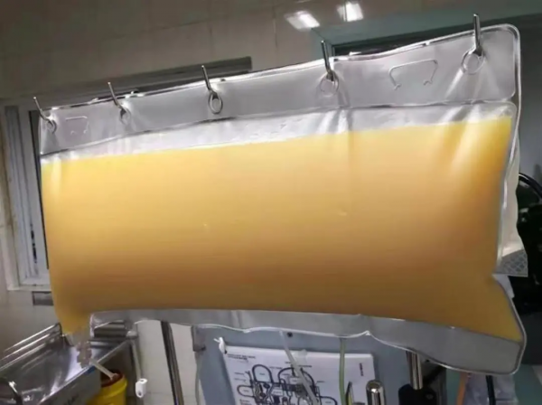 男子血液像牛奶,從中分離出近2升油漿!這些習慣很多人都有 男子血液像牛奶,從中分離出近2升油漿!這些習慣很多人都有