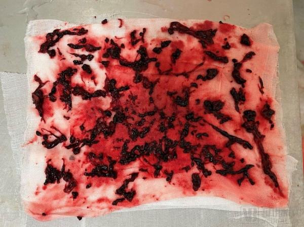 血栓清除率超90％，取出亞急性血栓，樂奧醫療靜脈取栓導管新突破