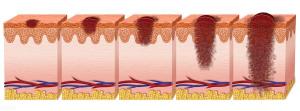黑色素瘤的症狀有哪些? 黑色素瘤的症狀有哪些?